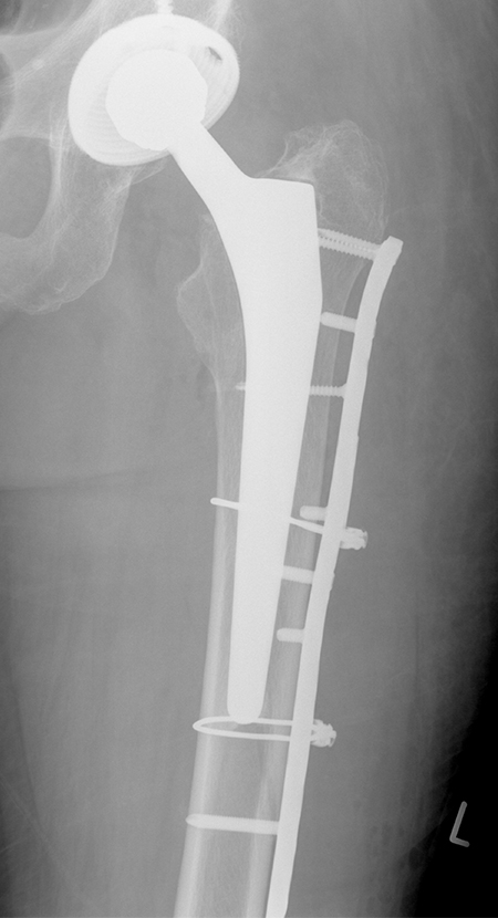 Bild periprothetische Fraktur nach OP