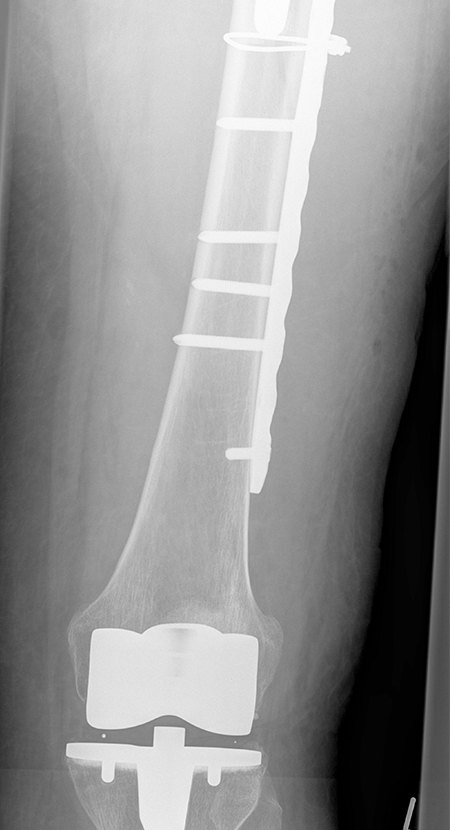 Bild periprothetische Fraktur nach OP