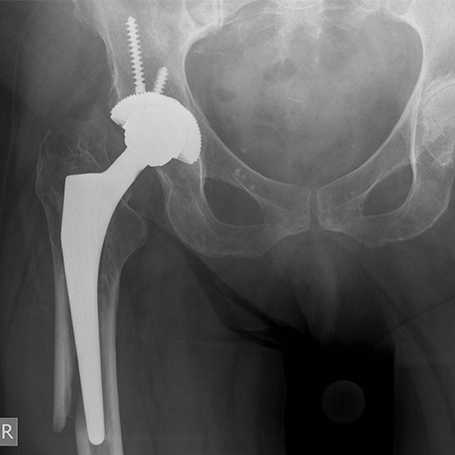 Bild periprothetische Fraktur vor OP