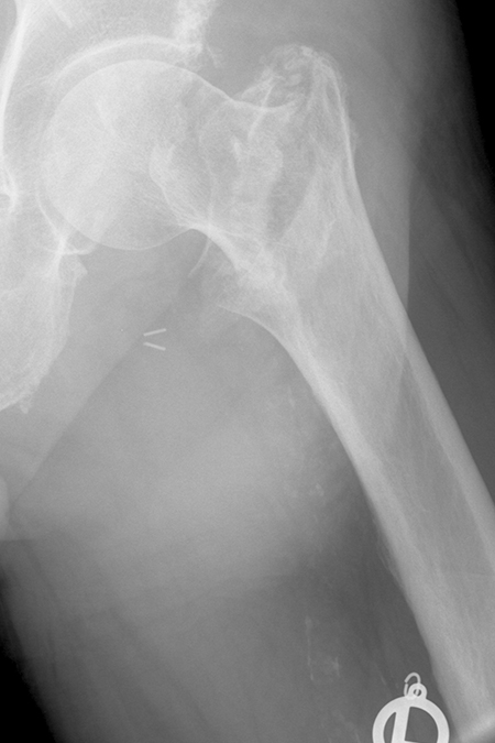 Bild pertrochantaere Fraktur