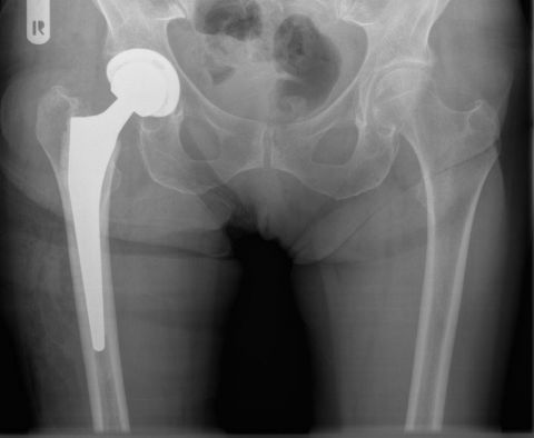 Bild Beckenübersicht nach OP