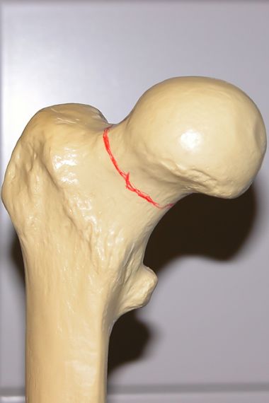 Bild Frakturverlauf Schenkelhalsfraktur Modell