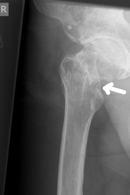 Bild inked Schenkelhalsfraktur zementierte TEP