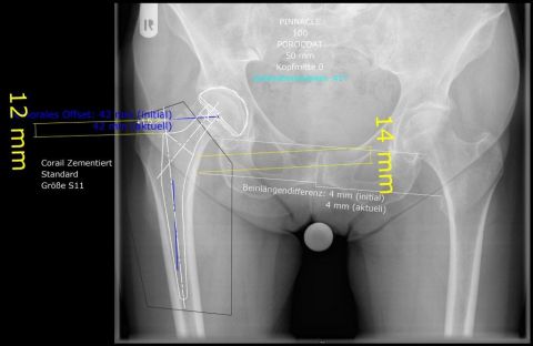 Bild Planung Hüftendoprothese