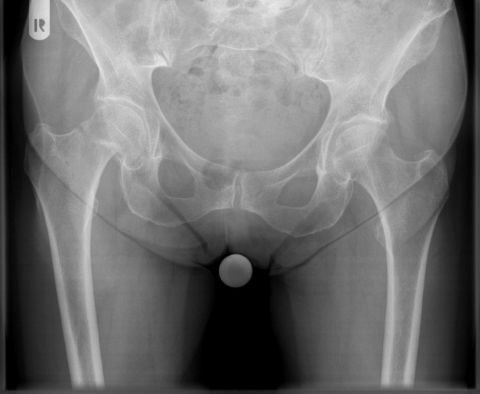 Bild rechtsseitige Schenkelhalsfraktur