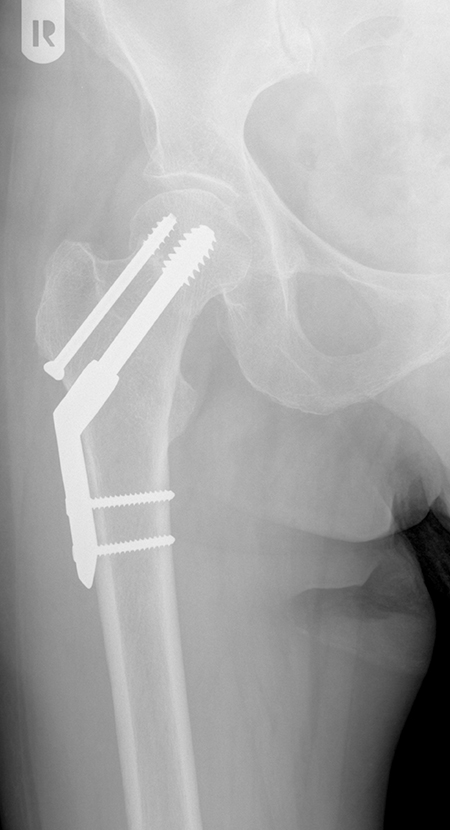 Bild Schenkelhalsfraktur nicht disloziert DHS Antirot