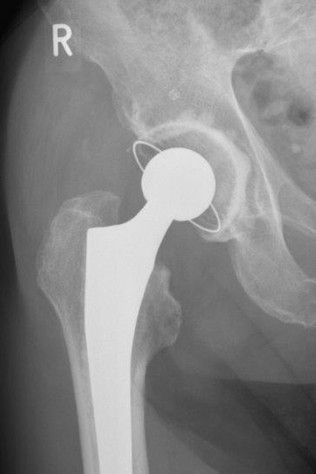 Bild Schenkelhalsfraktur zementierte TEP