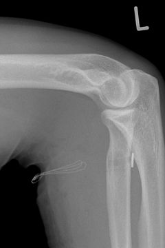 Bild Bizepssehnenrefixation