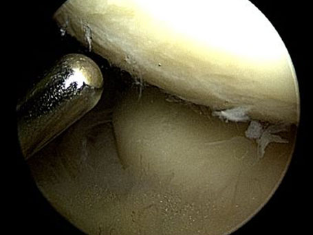 Bild Ellenbogenarthroskopie Oberarmrolle und Speichenköpfchen