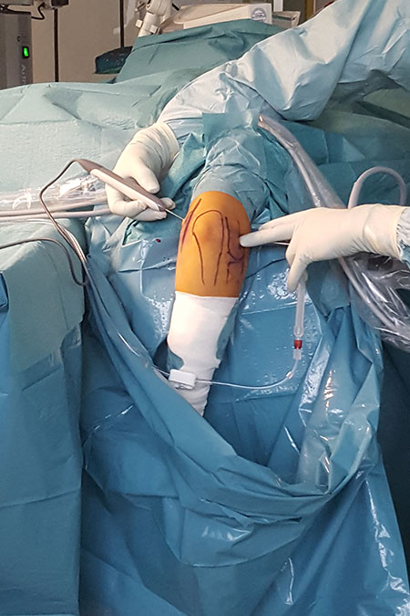 Bild Ellenbogengelenksarthroskopie