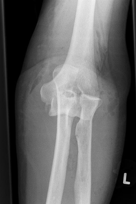 Bild Ellenbogengelenk Herausgesprungen frontal