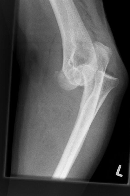 Bild Ellenbogengelenk Herausgesprungen seitlich