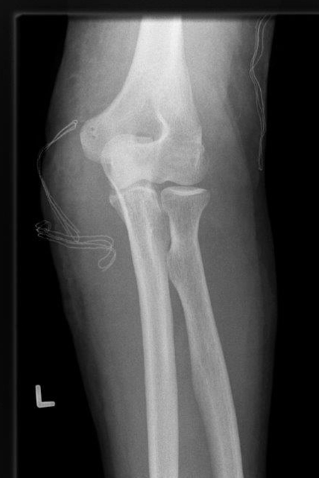 Bild Ellenbogengelenk zentriert nach OP frontal