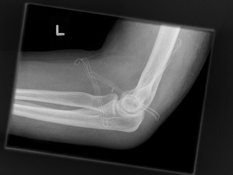 Bild Ellenbogengelenk zentriert nach OP seitlich