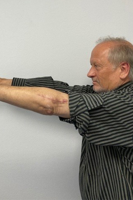 Bild Ellenbogenluxation nach OP streckt die Arme vom Körper