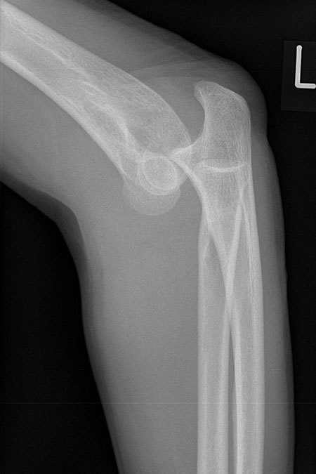 Bild Ellenbogenluxation