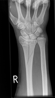 Bild Radiusfraktur komplex