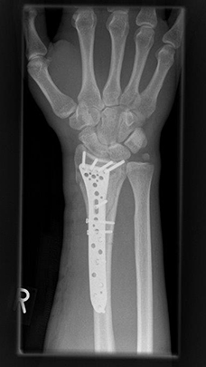 Bild Radiusfraktur komplex Osteosynthese