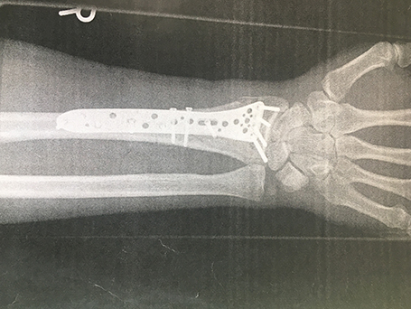 Bild Radiusfraktur komplex frontal nach Osteosynthese