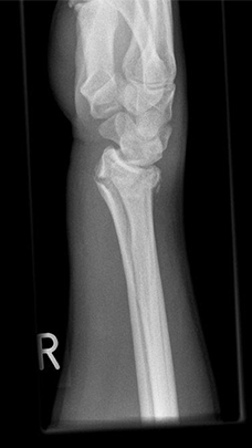 Bild Radiusfraktur komplex seitlich