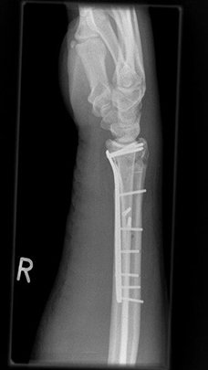Bild Radiusfraktur komplex seitlich nach Osteosynthese