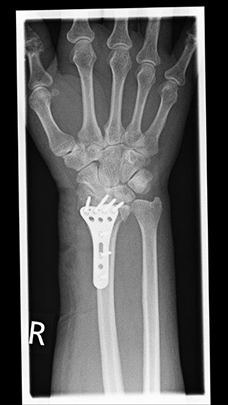 Bild Radiusfraktur vor Korrekturoperation