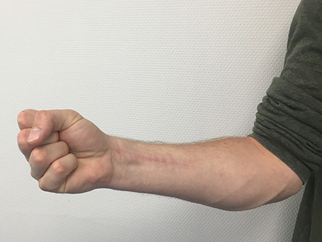 Bild Patient ballt die Faust nach OP