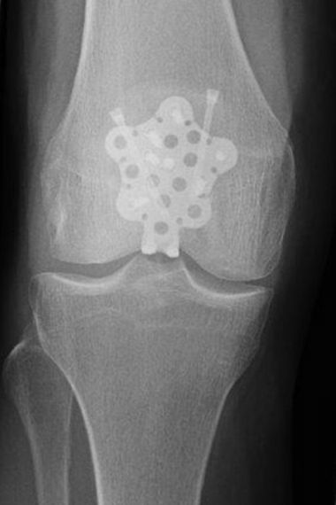 Bild Kniescheibenbruch Ausheilungsergebnis