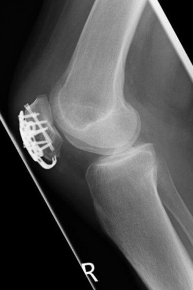 Bild Kniescheibenbruch Ausheilungsergebnis Starplatte seitlich