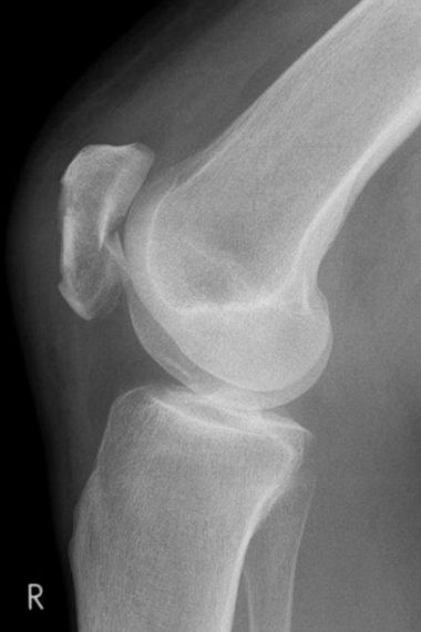 Bild Kniescheibenbruch mehrfragmentaer seitlich