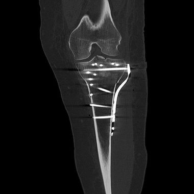 Bild CT Untersuchung nach Rekonstruktion mit glatter Gelenkflaeche
