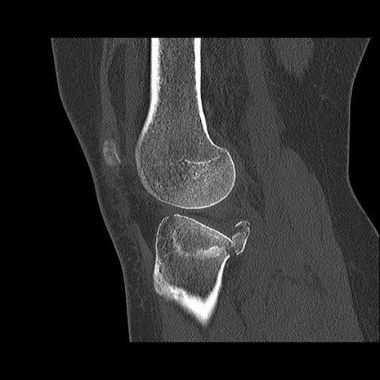 Bild CT Untersuchung vor Operation Tibiakopffraktur