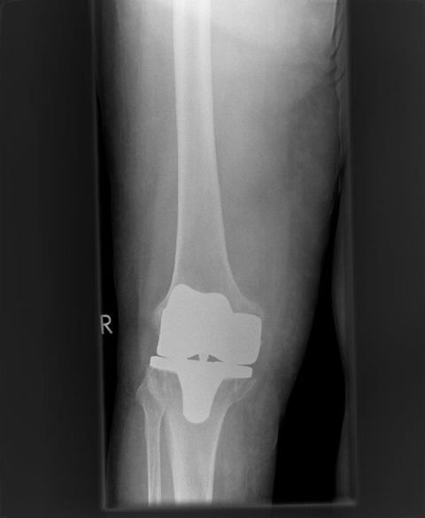Bild eingesunkenes tibiaplateau bei septischem Kniegelenk