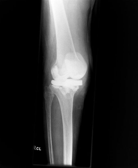 Bild Interimsplatzhalter bei mehrfachem septischem Wechsel mit antibiotikahaltigem Zement