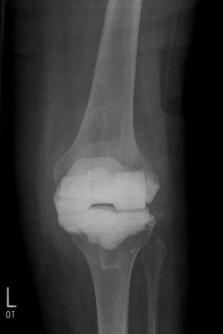 Bild interimsprothese bei Infektionsbehandlung Knie TEP