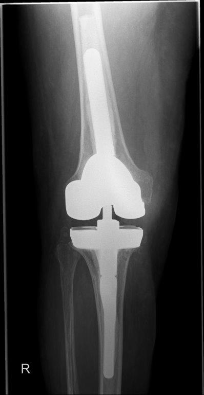 Bild radiologisches Ergebnis nach mehrfachem Wechsel Knie TEP