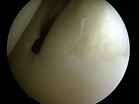 Bild außenseitiges Kniegelenk