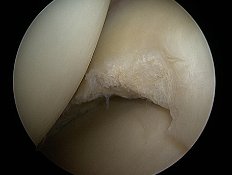 Bild gesäuberte Meniskuskante