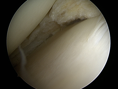 Bild gesäuberte Meniskuskante