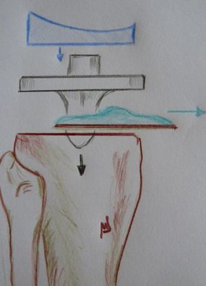 Bild Knie TEP Zeichnung Tibiaplateau