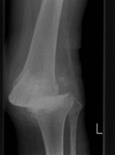 Bild Rheuma und Bakterieller Infekt