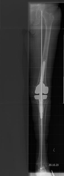 Bild Rheuma und bakterieller Infekt