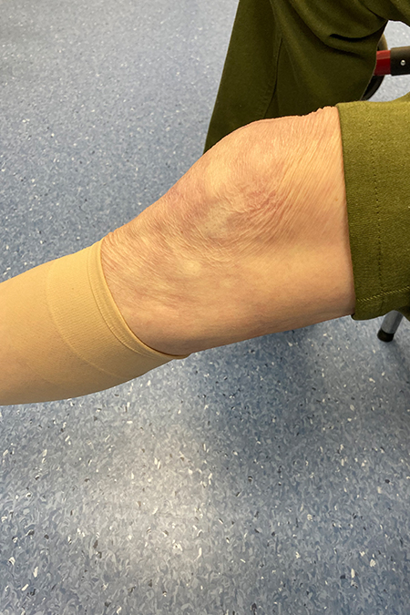 Bild Patient Knie nach Schlittenendoporthese