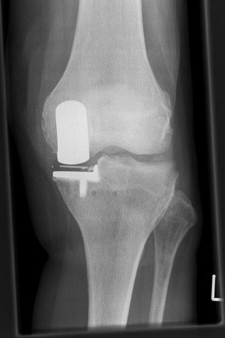 Bild nach Schlittenendoprothese