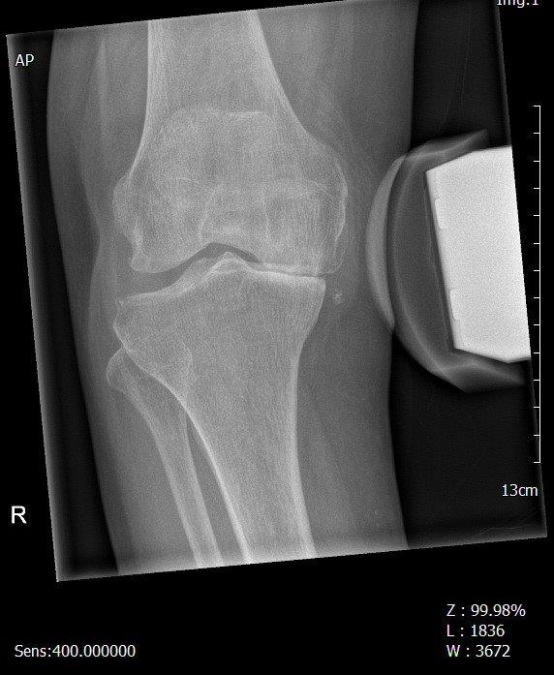 Bild gehaltene Aufnahme bei innenseitigem Knorpelverlust