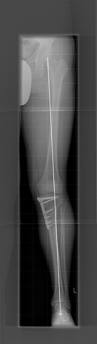 Bild HTO mit Tomofixplatte nach OP