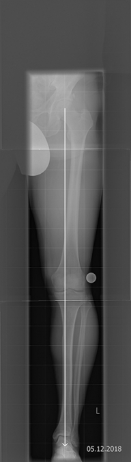 Bild HTO mit Tomofixplatte vor OP