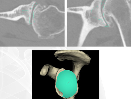 Bild von Planung Glenoid