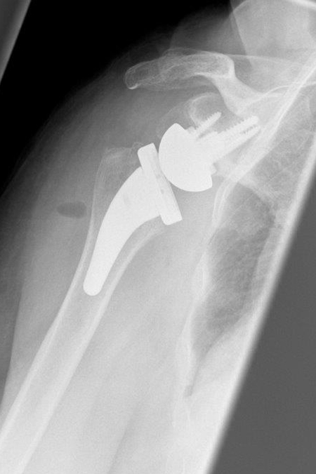 Bild Omarthrose nach der OP