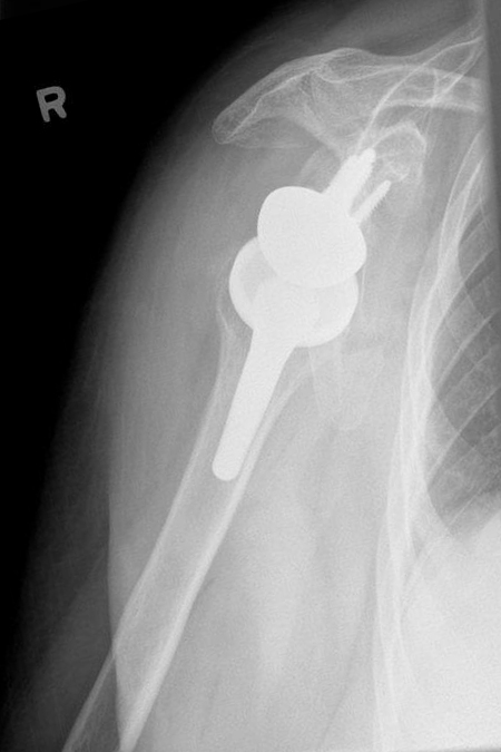 Bild Omarthrose nach der OP